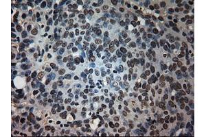 Immunohistochemical staining of paraffin-embedded Adenocarcinoma of colon tissue using anti-PROM2mouse monoclonal antibody. (Prominin 2 抗体)