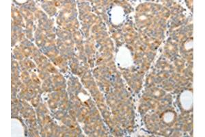 The image on the left is immunohistochemistry of paraffin-embedded Human thyroid cancer tissue using (TEP1 Antibody) at dilution 1/50, on the right is treated with synthetic peptide. (TEP1 抗体)