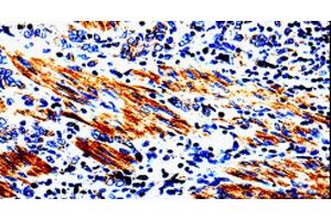 Immunohistochemistry of paraffin-embedded Human stomach cancer tissue using ACSBG2 Polyclonal Antibody at dilution 1:60 (ACSBG2 抗体)