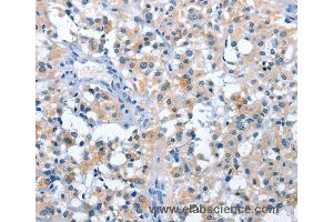 Immunohistochemistry of Human thyroid cancer using ASB2 Polyclonal Antibody at dilution of 1:50 (ASB2 抗体)