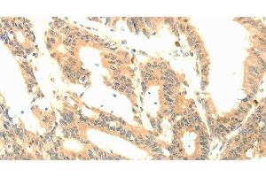 Immunohistochemistry of paraffin-embedded Human colon cancer tissue using P23 Polyclonal Antibody at dilution 1:50 (CDK5R1 抗体)