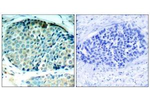 Immunohistochemical analysis of paraffin-embedded human breast carcinoma tissue, using HSP27 (phospho- Ser78) antibody (E011247). (HSP27 抗体  (pSer78))