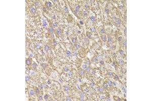 Immunohistochemistry of paraffin-embedded human liver injury using CIAPIN1 Antibody. (CIAPIN1 抗体  (AA 1-312))