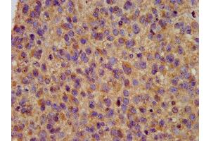 IHC image of ABIN7163983 diluted at 1:200 and staining in paraffin-embedded human glioma performed on a Leica BondTM system. (Kcne3 抗体  (AA 1-57))