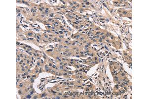 Immunohistochemistry of Human lung cancer using PEBP1 Polyclonal Antibody at dilution of 1:40 (PEBP1 抗体)