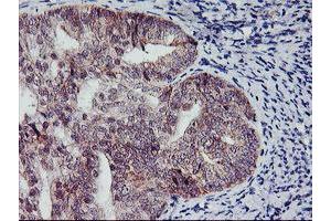 Immunohistochemical staining of paraffin-embedded Adenocarcinoma of Human endometrium tissue using anti-NAPEPLD mouse monoclonal antibody. (NAPEPLD 抗体)