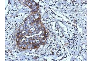 AP31123PU-N RGS4 antibody staining of Paraffin-Embedded Breast Carcinoma at 1/500 dilution. (RGS4 抗体  (AA 1-188))