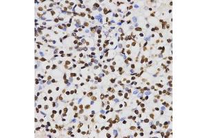 Immunohistochemistry of paraffin-embedded human kidney cancer using Dimethyl-Histone H3-K4 antibody (ABIN5969803) at dilution of 1/200 (40x lens). (Histone 3 抗体  (H3K4me2))
