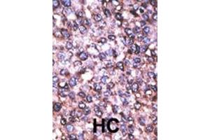 Formalin-fixed and paraffin-embedded human cancer tissue reacted with the primary antibody, which was peroxidase-conjugated to the secondary antibody, followed by AEC staining. (MAGED2 抗体  (C-Term))