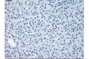 Immunohistochemical staining of paraffin-embedded Adenocarcinoma of ovary tissue using anti-SORDmouse monoclonal antibody. (SORD 抗体)