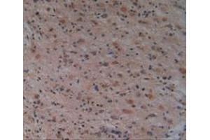 Detection of PAK1 in Human Glioma Tissue using Polyclonal Antibody to p21 Protein Activated Kinase 1 (PAK1) (PAK1 抗体  (AA 252-501))