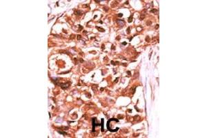 Formalin-fixed and paraffin-embedded human hepatocellular carcinoma tissue reacted with STAT5A (phospho Y694) polyclonal antibody  which was peroxidase-conjugated to the secondary antibody followed by DAB staining. (STAT5A 抗体  (pTyr694))