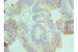 Immunohistochemistry of paraffin-embedded human colon cancer using ABIN7149071 at dilution of 1:100 (AXUD1 抗体  (AA 1-200))