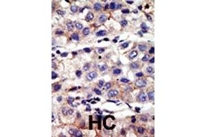 Formalin-fixed and paraffin-embedded human hepatocellular carcinoma tissue reacted with CBX4 polyclonal antibody  , which was peroxidase-conjugated to the secondary antibody, followed by AEC staining. (CBX4 抗体  (N-Term))