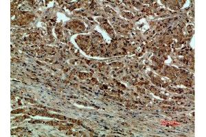 Immunohistochemical analysis of paraffin-embedded human-breast-cancer, antibody was diluted at 1:200 (DCT 抗体  (AA 1268-1341))