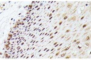 Immunohistochemistry of paraffin-embedded Human esophageal using MLF2 Polyclonal Antibody at dilution of 1:100 (40x lens). (MLF2 抗体)