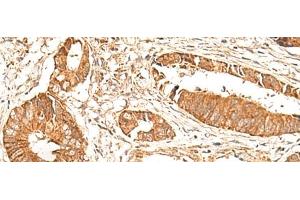 Immunohistochemistry of paraffin-embedded Human colorectal cancer tissue using BAG3 Polyclonal Antibody at dilution of 1:35(x200) (BAG3 抗体)