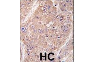 Formalin-fixed and paraffin-embedded human hepatocarcinoma tissue reacted with hUVRAG (Center) (ABIN388587 and ABIN2849985) , which was peroxidase-conjugated to the secondary antibody, followed by DAB staining. (UVRAG 抗体  (AA 366-398))