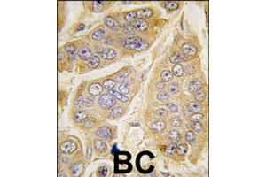Formalin-fixed and paraffin-embedded human breast carcinoma tissue reacted with NANOS1 polyclonal antibody  , which was peroxidase-conjugated to the secondary antibody, followed by DAB staining.
