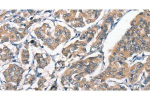 Immunohistochemistry of paraffin-embedded Human breast cancer tissue using HGF Polyclonal Antibody at dilution 1:65 (HGF 抗体)