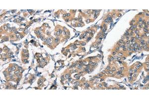 Immunohistochemistry of paraffin-embedded Human breast cancer tissue using HGF Polyclonal Antibody at dilution 1:65
