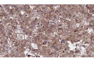 ABIN6273967 at 1/100 staining Human liver cancer tissue by IHC-P. (OR1G1 抗体  (Internal Region))