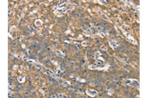 The image on the left is immunohistochemistry of paraffin-embedded Human gastric cancer tissue using ABIN7190368(CSMD1 Antibody) at dilution 1/40, on the right is treated with synthetic peptide. (CSMD1 抗体)