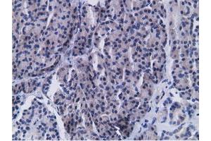 Immunohistochemical staining of paraffin-embedded Carcinoma of Human kidney tissue using anti-CD80 mouse monoclonal antibody. (CD80 抗体)