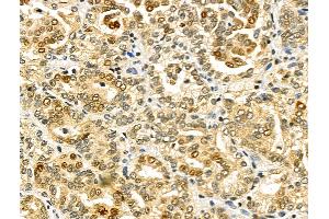 ABIN6259505 and ABIN6275797 at 1/100 staining Human kidney cancer by IHC-P. (CHFR 抗体  (Internal Region))
