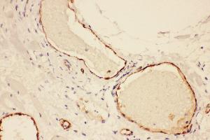 Anti-VWF Picoband antibody,  IHC(P): Human Lung Cancer Tissue (VWF 抗体  (AA 2535-2813))
