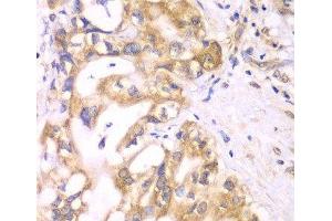 Immunohistochemistry of paraffin-embedded Human liver cancer using ACADS Polyclonal Antibody at dilution of 1:100 (40x lens). (ACADS 抗体)