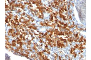 Formalin-fixed, paraffin-embedded human Lymphoma stained with CD79a Monoclonal Antibody (IGA/515). (CD79a 抗体)