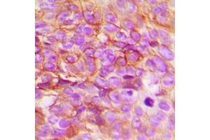 Immunohistochemical analysis of STEAP3 staining in human breast cancer formalin fixed paraffin embedded tissue section. (STEAP3 抗体  (C-Term))