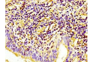 IHC image of ABIN7147154 diluted at 1:100 and staining in paraffin-embedded human lung cancer performed on a Leica BondTM system.