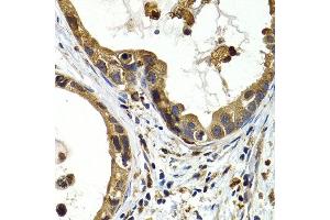 Immunohistochemistry of paraffin-embedded human stomach cancer using CTSS antibody at dilution of 1:200 (400x lens). (Cathepsin S 抗体)