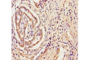 Immunohistochemistry of paraffin-embedded human pancreatic cancer using ABIN7166456 at dilution of 1:100 (TPST2 抗体  (AA 26-377))