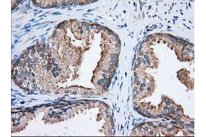 Immunohistochemical staining of paraffin-embedded Adenocarcinoma of Human ovary tissue using anti-EIF2S1 mouse monoclonal antibody.