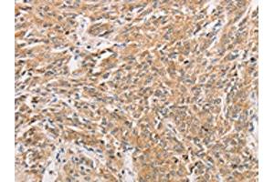 The image on the left is immunohistochemistry of paraffin-embedded Human prostate cancer tissue using ABIN7131608(WNT11 Antibody) at dilution 1/20, on the right is treated with fusion protein. (WNT11 抗体)