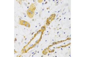 Immunohistochemistry of paraffin-embedded human liver cancer using KIF1B Antibody (ABIN5973994) at dilution of 1/100 (40x lens).