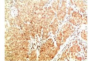 Immunohistochemical analysis of paraffin-embedded Human Breast Carcinoma Tissue using Acetyl NF kB P65(K314/K315) Mouse mAb diluted at 1:200.