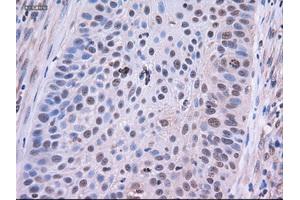 Immunohistochemical staining of paraffin-embedded Adenocarcinoma of colon using anti-EpCAM (ABIN2452541) mouse monoclonal antibody. (EpCAM 抗体  (AA 24-265))