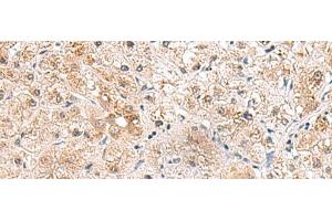 Immunohistochemistry of paraffin-embedded Human liver cancer tissue using RTKN2 Polyclonal Antibody at dilution of 1:75(x200)