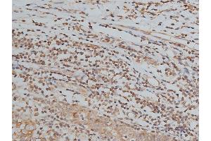 ABIN6267039 at 1/200 staining human breast cancer tissue sections by IHC-P. (Histone 3 抗体)