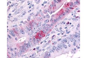Anti-MAP3K9 antibody IHC of human colon cancer. (MAP3K9 抗体  (Internal Region))