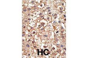 Formalin-fixed and paraffin-embedded human hepatocellular carcinoma tissue reacted with the PIAS4 polyclonal antibody  , which was peroxidase-conjugated to the secondary antibody, followed by DAB staining. (PIAS4 抗体  (N-Term))