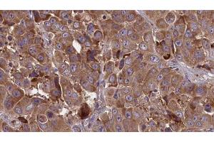 ABIN6273847 at 1/100 staining Human liver cancer tissue by IHC-P. (OR51J1 抗体)