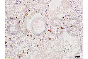 Formalin-fixed and paraffin embedded human ovary carcinoma labeled Anti-CDKN1B/P27kip1 Polyclonal Antibody, Unconjugated (ABIN672621) at 1:200, followed by conjugation to the secondary antibody and DAB staining (CDKN1B 抗体  (AA 150-198))
