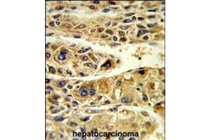 Formalin-fixed and paraffin-embedded human hepatocarcinoma reacted with ADH6 Antibody (Center), which was peroxidase-conjugated to the secondary antibody, followed by DAB staining. (ADH6 抗体  (AA 209-240))