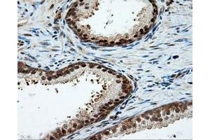 Immunohistochemical staining of paraffin-embedded Carcinoma of liver tissue using anti-LIPG mouse monoclonal antibody. (LIPG 抗体)