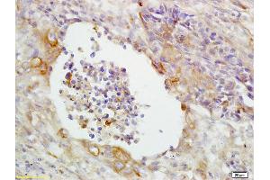 Formalin-fixed and paraffin embedded human lung carcinoma labeled with Anti-CD14 Polyclonal Antibody, unconjugated  (ABIN673164)  at 1: 200 followed by incubation with conjugated secondary antibody and DAB staining (CD14 抗体  (AA 201-300))